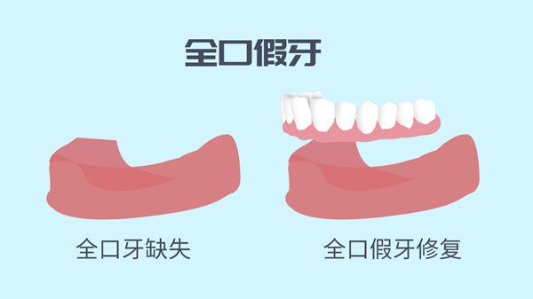 全口假牙