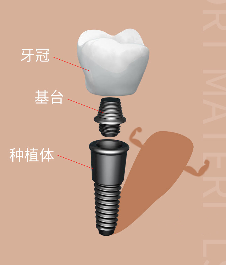 种植牙结构图